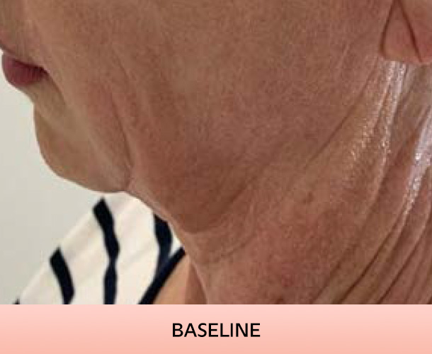 Jawline before triLift treatment
